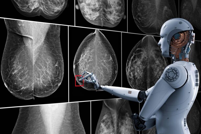 Inteligencia Artificial detecta cáncer de mama en etapa temprana tras mamografía normal